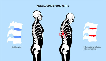 Ankylosing spondylitis disease - 660910868