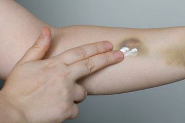 Female hand applying medicine cream on bruised skin, closeup