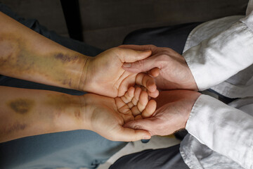 Bruise on the patient's arm and doctor's hand closeup. Aid, medicine and treatment for patient concept - obrazy, fototapety, plakaty