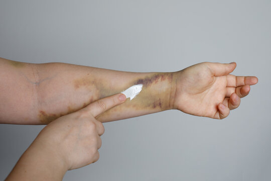 Woman applying white cream bruised skin on her arm on grey background
