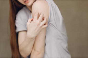 Allergy dermatology scabies itches hand skin problem woman