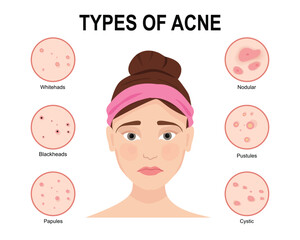 Types of acne. Skin problems