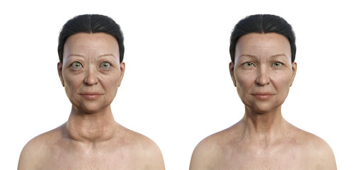 A woman with Graves' disease and the same healthy person, 3D illustration