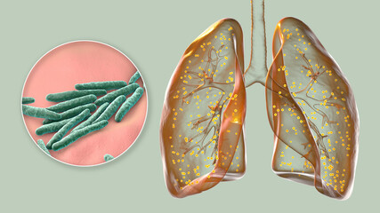 Human lungs affected by miliary tuberculosis, and close-up view of Mycobacterium tuberculosis, 3D illustration