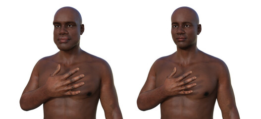 Acromegaly in a man, and the same healthy person, 3D illustration - obrazy, fototapety, plakaty