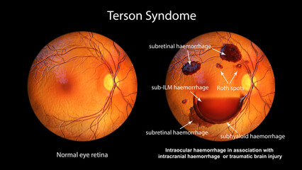 A 3Dl illustration of Terson syndrome, revealing intraocular hemorrhage observed during ophthalmoscopy - obrazy, fototapety, plakaty