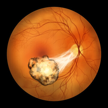 Toxoplasma retinochoroiditis observed during ophthalmoscopy, an illustration