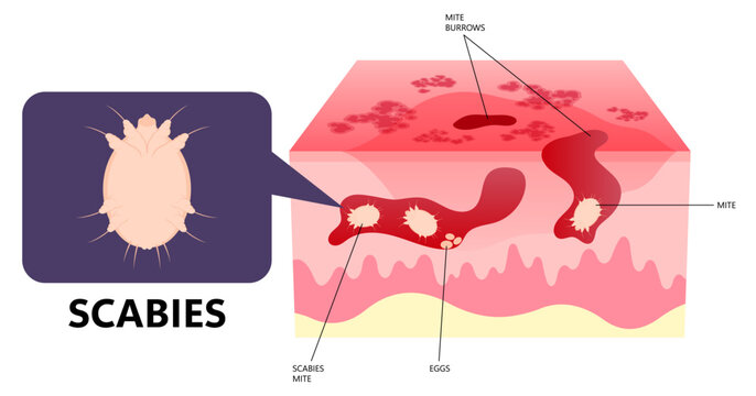 Eczema or dermatitis of skin red and itching