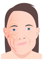Face nerve injury central motor neuron infectious or ptosis of bell's cranial hyperacusis in the hemiplegia nystagmus and chicken pox skin simplex otalgia tinnitus multiple sclerosis