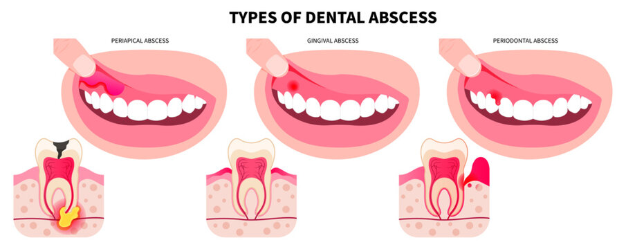 Cracked and broken wisdom teeth Cavities the swollen pain of oral cavity in bad breath hygiene health