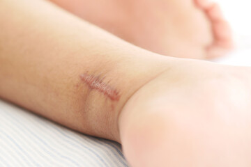 Stitched wound mark on a child foot.