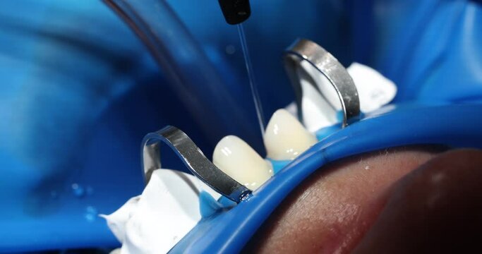 Dental process of cleaning teeth in patient mouth. Clean your teeth with jet of water and saliva ejector