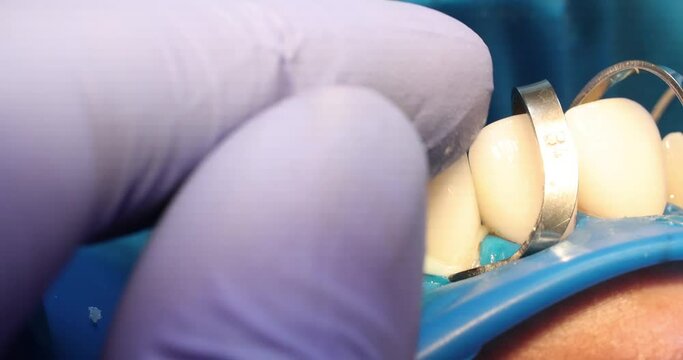 Dental care and process of installing veneers. Installation of veneers in dentistry