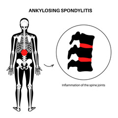 Ankylosing spondylitis disease