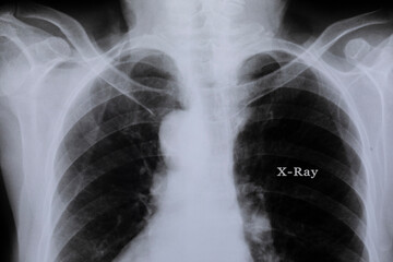 Spine bone x-ray film on white background.
