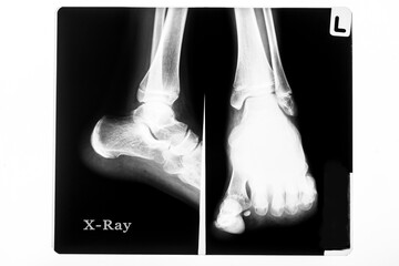 X ray image of a foot.