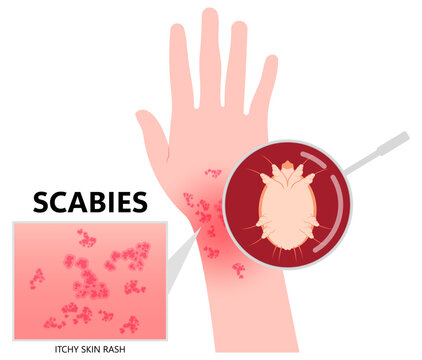 Hand and wrist the dermis skin inflammation with red itching caused by scabies in medical