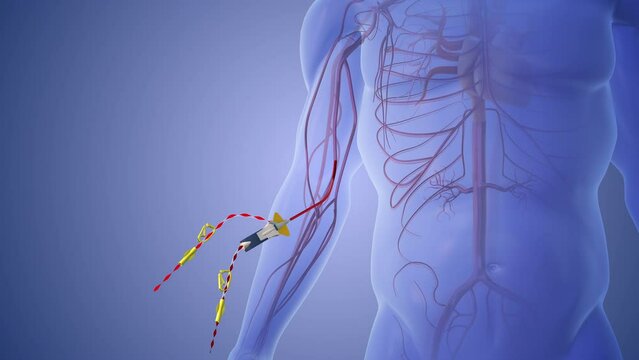 Medical concept of Combining aesthetics and feasibility in PICC port placement
