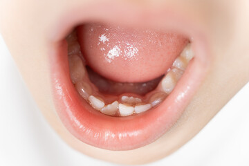 Crookedly growing teeth to replace milk teeth in a child. The second row of teeth, the tooth grows...