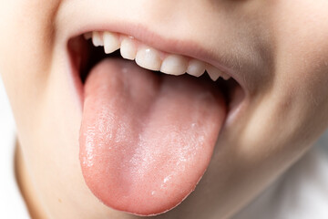 The tongue of a six-year-old healthy child, papillae on the tongue
