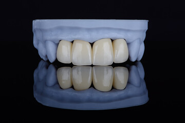High-quality naturally dental single crowns made of zirconium for fixation to the frontal teeth of upper jaw. © gorynvd