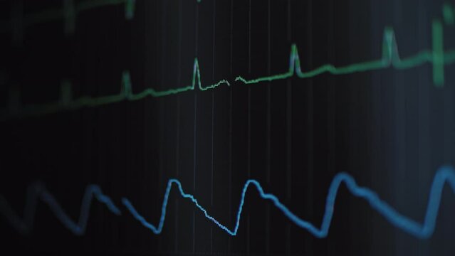 Heart rhythm on medical monitor screen