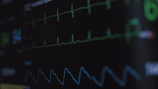 Heart rhythm on medical monitor screen