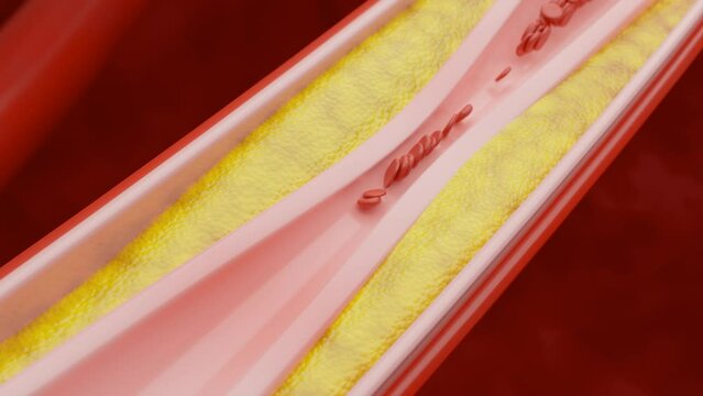 Thrombus formation in a vein and calcium deposition on the vessel walls.Blood clot in coronary artery.Hyperlipidemia or arteriosclerosi.Blocked artery concept and human blood vessel as a disease with 