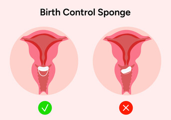 Birth control sponge illustration correct incorrect 