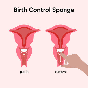 Birth control sponge illustration instruction 