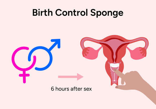 Birth control sponge medicine illustration
