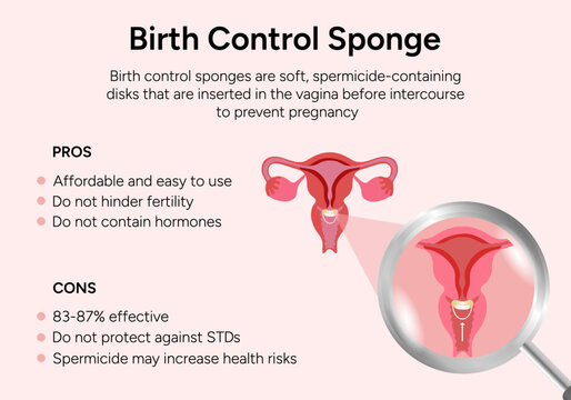 Birth control sponge illustration pros and cons