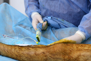 Medical surgery for endovenous laser photocoagulation of the great saphenous vein. Miniphlegectomy....