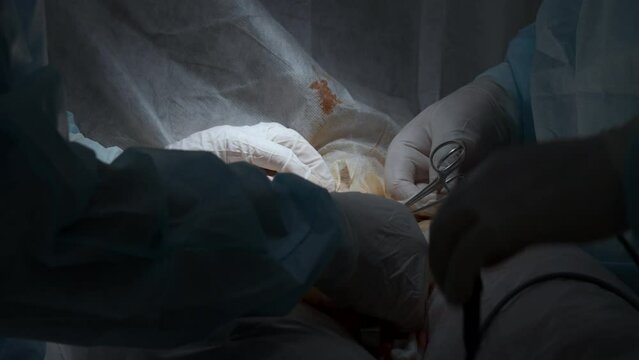Close up of professional surgeons cauterizing an open wound during medical procedure. Action. Doctors in clean uniform using professional equipment.