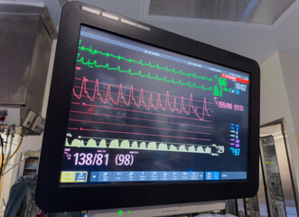 hospital monitor displaying vital signs: heart rate, blood pressure, temperature, and pulse oximetry, highlighting advanced medical technology in patient care