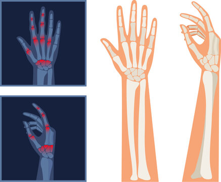 Finger arthritis vector illustration. Rheumatoid Arthritis hands x-ray. Pain in the human body. Arthritis, bone disease medical poster