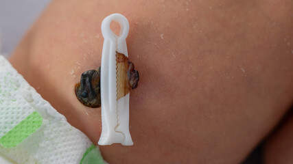 Close-up of a newborn's belly button with clothespin. 
