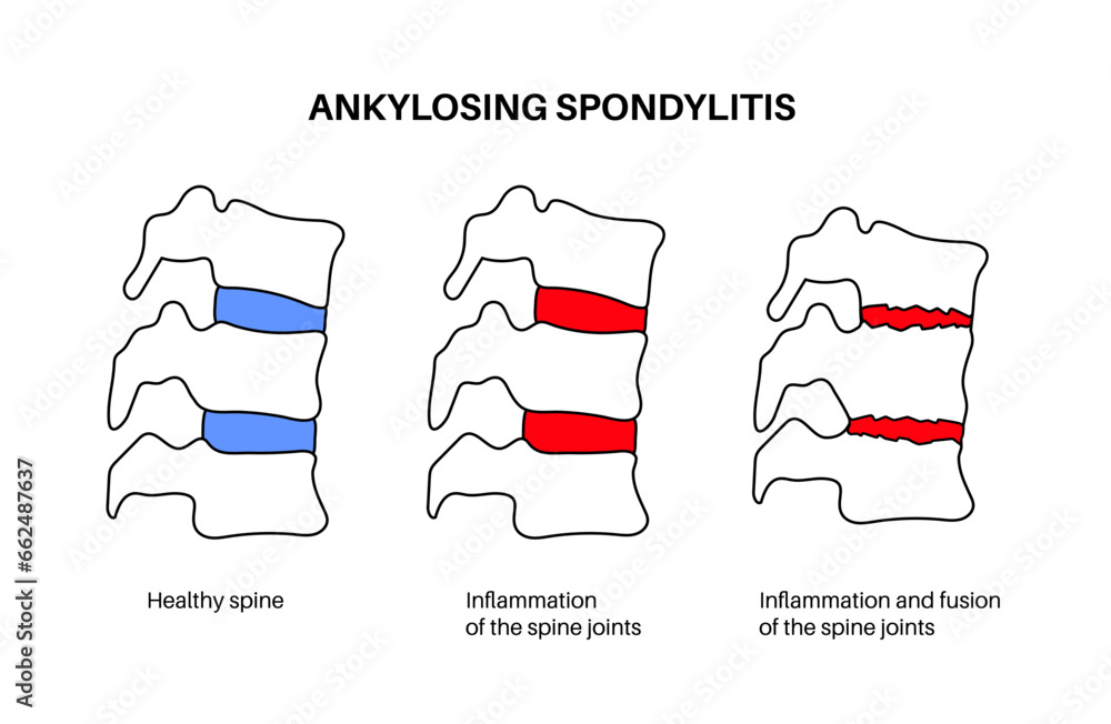 Canvas Prints Ankylosing spondylitis disease