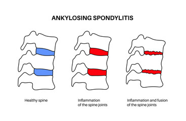 Ankylosing spondylitis disease