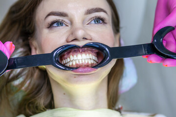 The process of removing braces. Beautiful woman with a mouth expander in a dental chair during the...