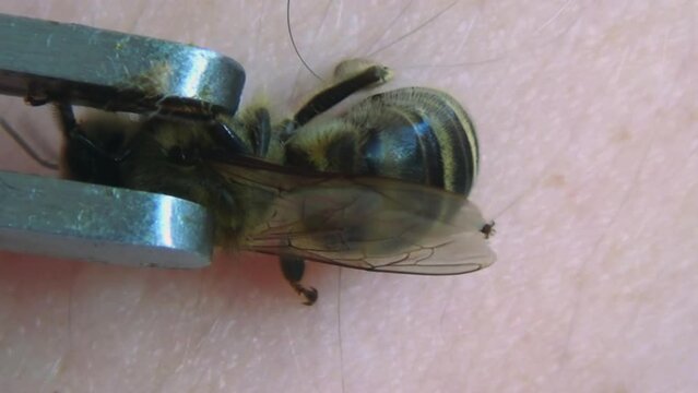 Apitherapy. With the help of tweezers, the bee is placed on the skin of a person and deliberately forced to sting. Bee stings for health and healing. Treatment of arthritis with bee venom