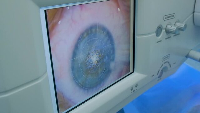 Ophthalmological equipment for vision correction. View of the monitor screen during eye cataract surgery.