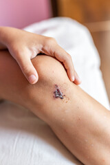 Close-up of a wound on the leg, a boy's bruise on the knee joint as a result of an accident or fall