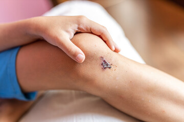 Close-up of a wound on the leg, a boy's bruise on the knee joint as a result of an accident or fall