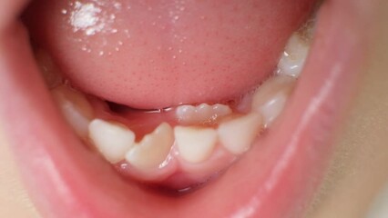 Crookedly growing teeth to replace milk teeth in a child. The second row of teeth, the tooth grows while the incisor has not yet fallen out.