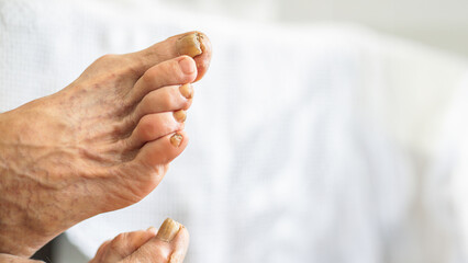 Close up of adult feet with various problems, calluses, dry skin, bunions, nails with mycoses and...