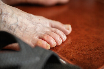 Close up of bare feet of an adult person with various health problems, calluses, dry skin, bunions,...