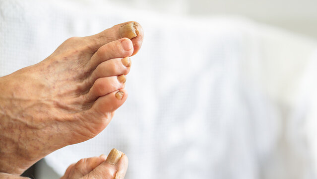 Close up of adult feet with various problems, calluses, dry skin, bunions, nails with mycoses and varicose veins.