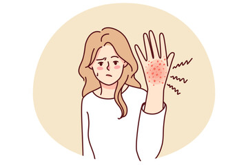 Obraz premium Unhappy woman suffer from redness on hand. Unwell girl struggle with psoriasis or seasonal allergy. Healthcare concept. Vector illustration.