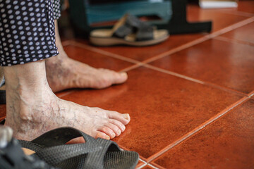 Close up of bare feet of an adult person with various health problems, calluses, dry skin, bunions,...